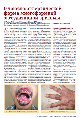 О токсикоаллергической форме многоформной экссудативной эритемы