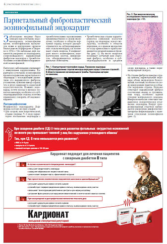   Париетальный фибропластический эозинофильный эндокардит