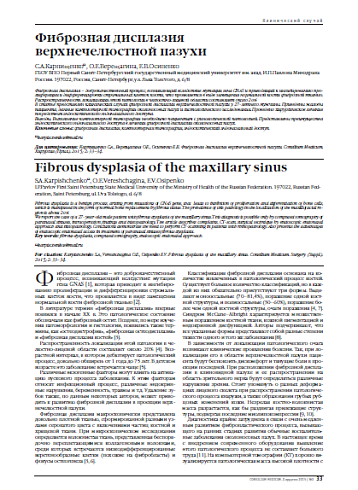 Фиброзная дисплазия  верхнечелюстной пазухи