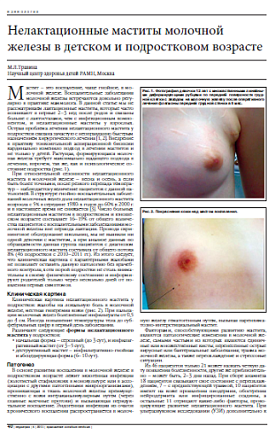 Нелактационные маститы молочной железы в детском и подростковом возрасте