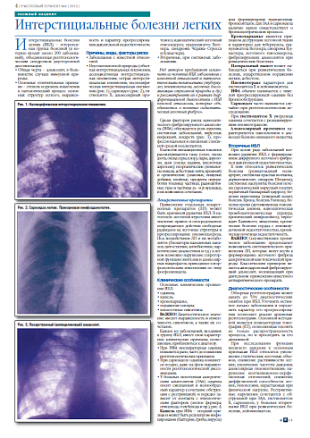 Интерстициальные болезни легких