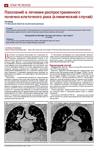 Пазопаниб в лечении распространенного почечно-клеточного рака (клинический случай)