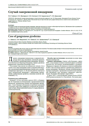 Случай гангренозной пиодермии